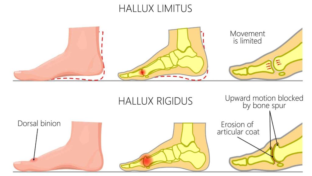 Best Hiking Boots For Hallux Rigidus